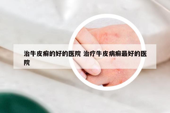 治牛皮癣的好的医院 治疗牛皮病癣最好的医院