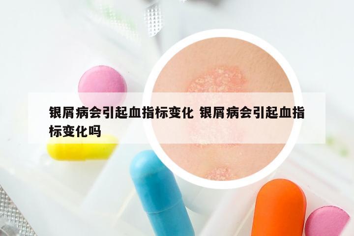 银屑病会引起血指标变化 银屑病会引起血指标变化吗