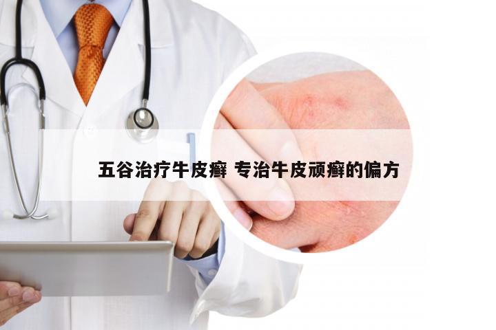 五谷治疗牛皮癣 专治牛皮顽癣的偏方
