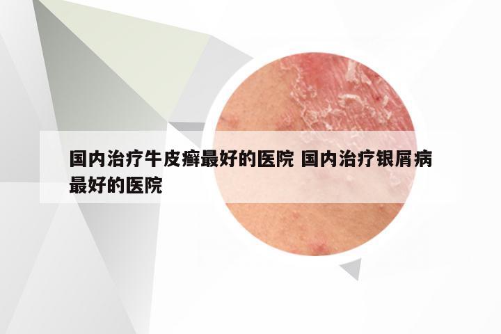 国内治疗牛皮癣最好的医院 国内治疗银屑病最好的医院