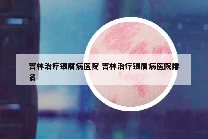吉林治疗银屑病医院 吉林治疗银屑病医院排名