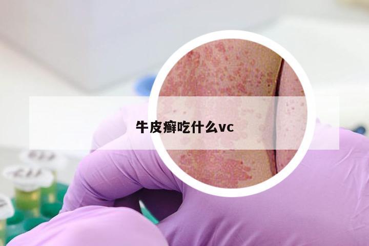 牛皮癣吃什么vc