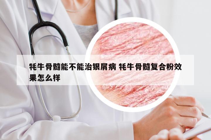 牦牛骨髓能不能治银屑病 牦牛骨髓复合粉效果怎么样