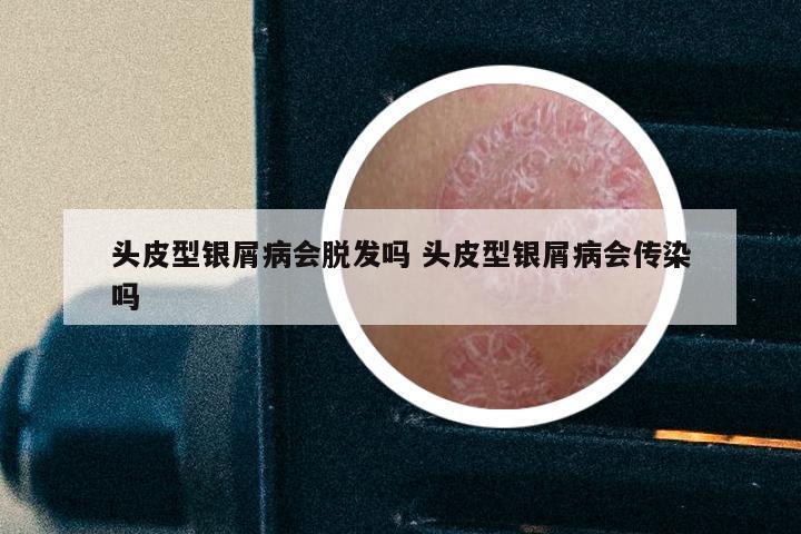 头皮型银屑病会脱发吗 头皮型银屑病会传染吗