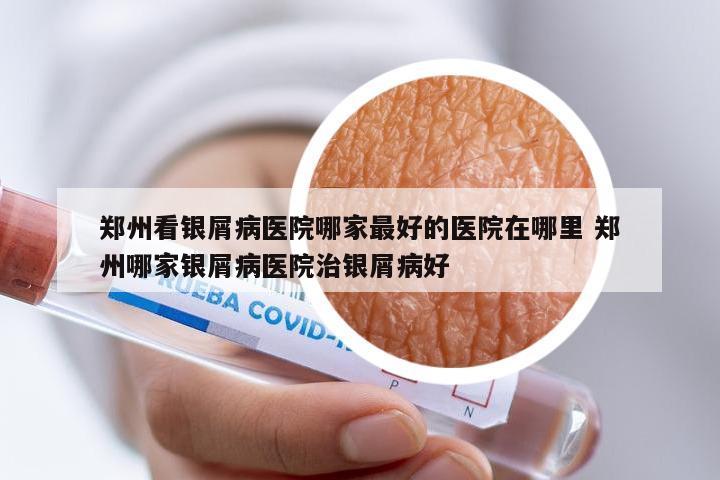 郑州看银屑病医院哪家最好的医院在哪里 郑州哪家银屑病医院治银屑病好