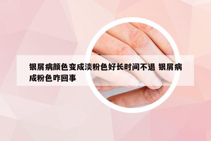 银屑病颜色变成淡粉色好长时间不退 银屑病成粉色咋回事