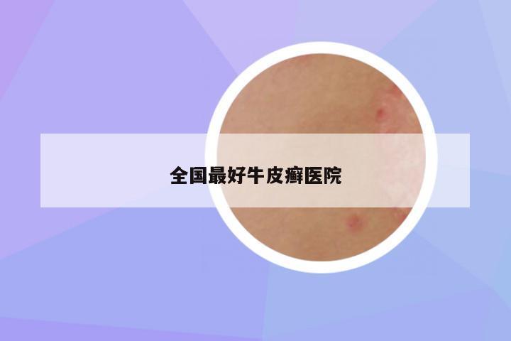 全国最好牛皮癣医院