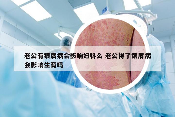 老公有银屑病会影响妇科么 老公得了银屑病会影响生育吗