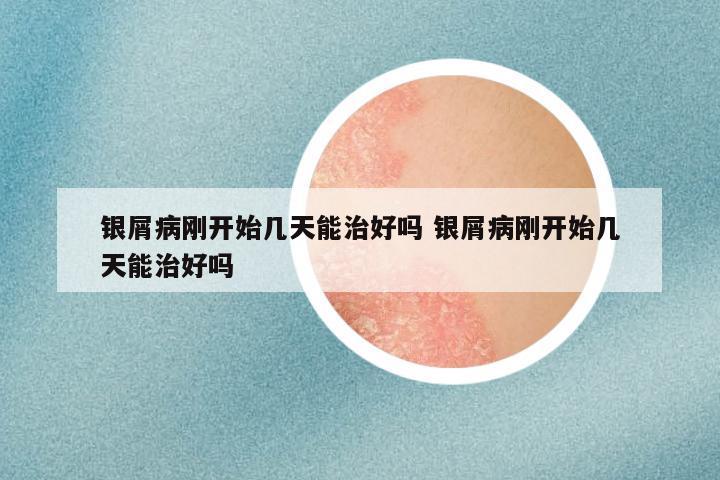 银屑病刚开始几天能治好吗 银屑病刚开始几天能治好吗