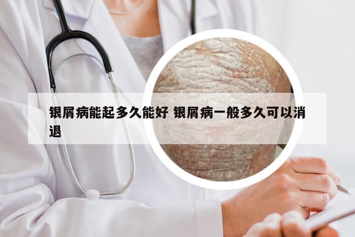 银屑病能起多久能好 银屑病一般多久可以消退