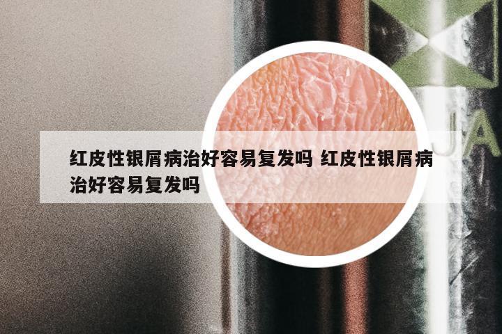 红皮性银屑病治好容易复发吗 红皮性银屑病治好容易复发吗