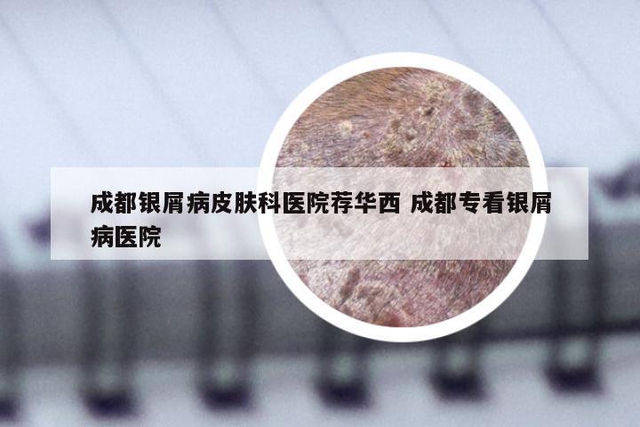 成都银屑病皮肤科医院荐华西 成都专看银屑病医院
