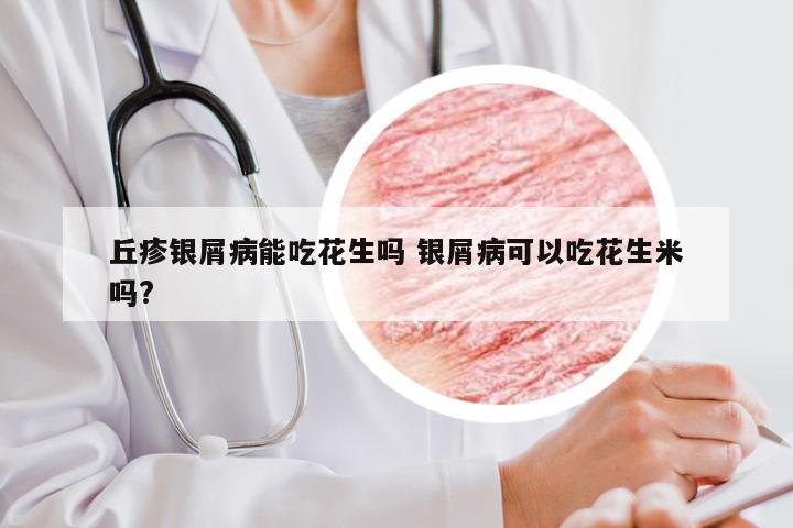 丘疹银屑病能吃花生吗 银屑病可以吃花生米吗?