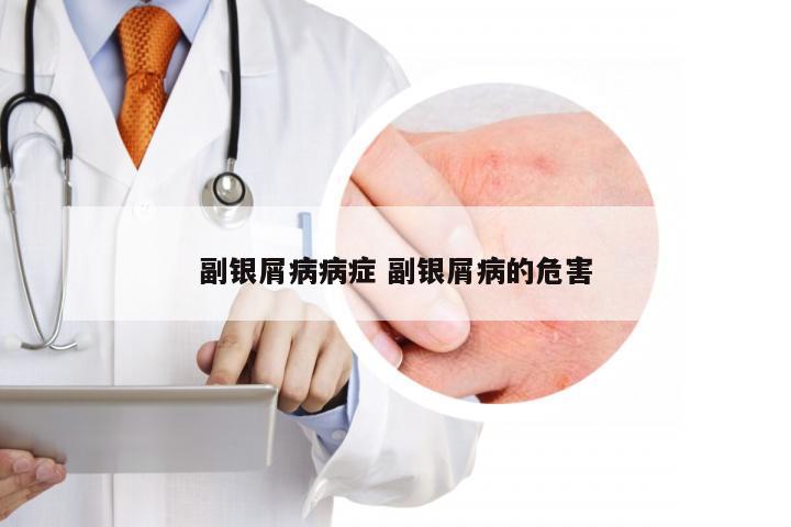 副银屑病病症 副银屑病的危害