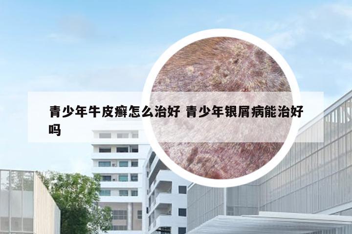 青少年牛皮癣怎么治好 青少年银屑病能治好吗