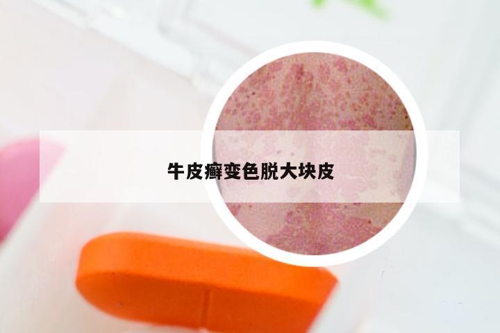 牛皮癣变色脱大块皮