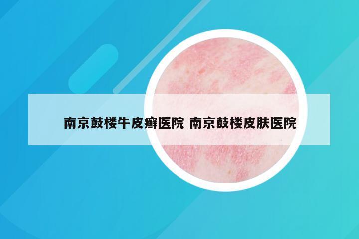 南京鼓楼牛皮癣医院 南京鼓楼皮肤医院