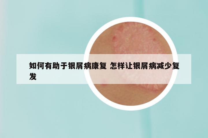 如何有助于银屑病康复 怎样让银屑病减少复发