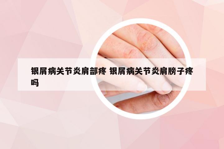 银屑病关节炎肩部疼 银屑病关节炎肩膀子疼吗