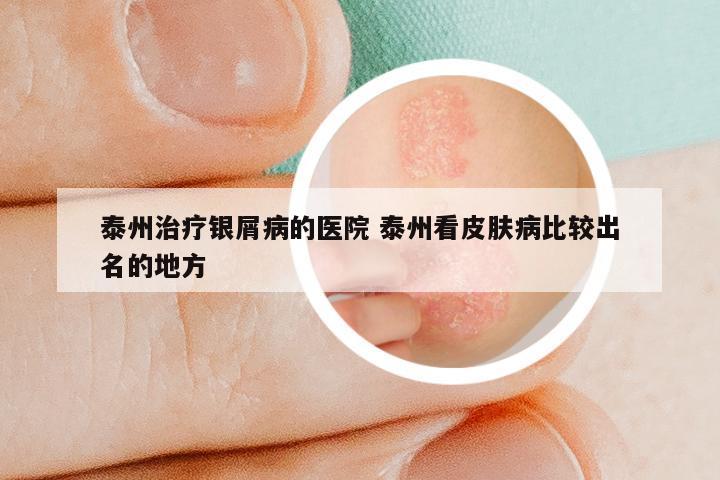 泰州治疗银屑病的医院 泰州看皮肤病比较出名的地方