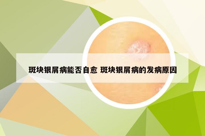 斑块银屑病能否自愈 斑块银屑病的发病原因