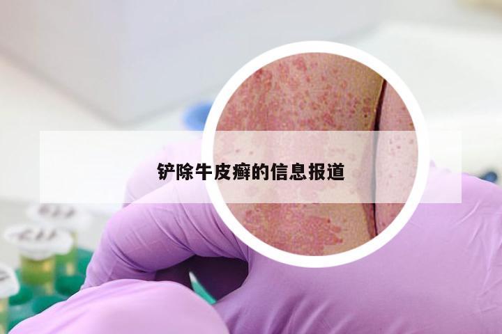 铲除牛皮癣的信息报道