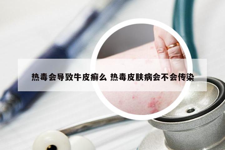 热毒会导致牛皮癣么 热毒皮肤病会不会传染