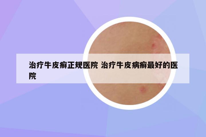 治疗牛皮癣正规医院 治疗牛皮病癣最好的医院