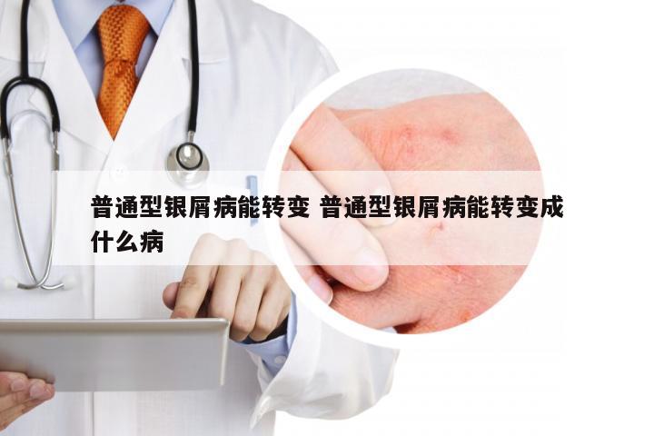 普通型银屑病能转变 普通型银屑病能转变成什么病