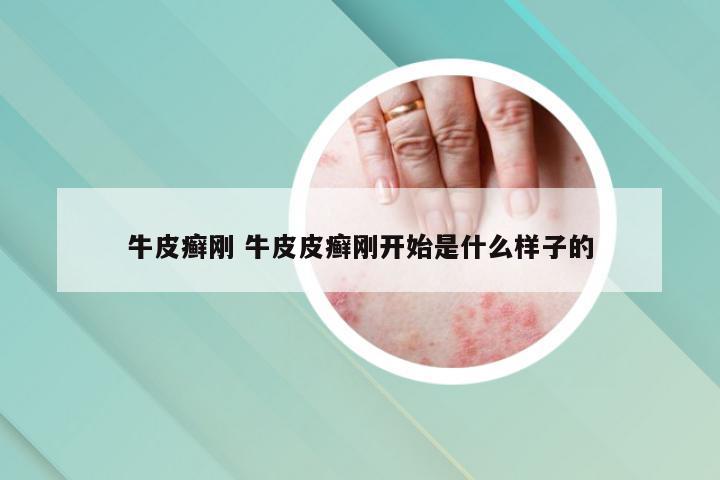 牛皮癣刚 牛皮皮癣刚开始是什么样子的