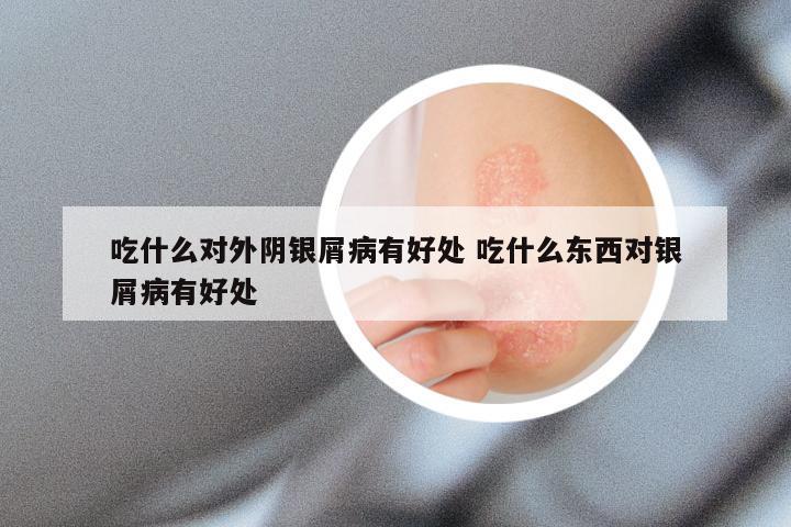 吃什么对外阴银屑病有好处 吃什么东西对银屑病有好处
