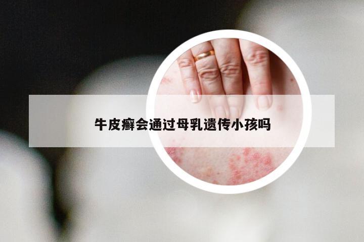 牛皮癣会通过母乳遗传小孩吗