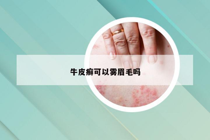 牛皮癣可以雾眉毛吗