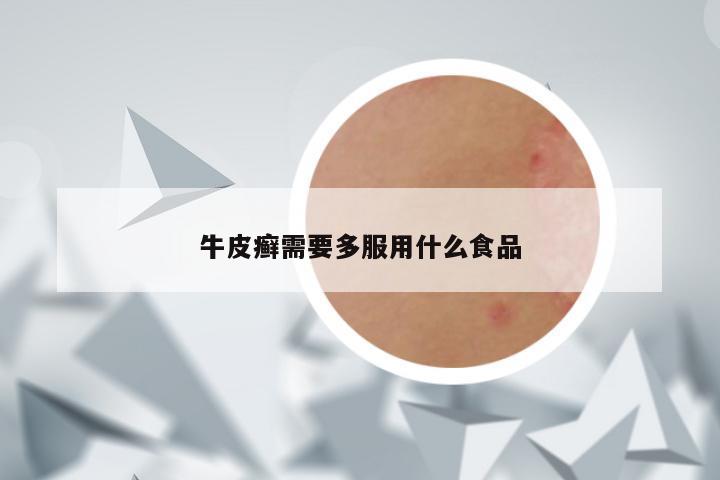 牛皮癣需要多服用什么食品