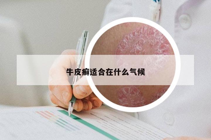 牛皮癣适合在什么气候