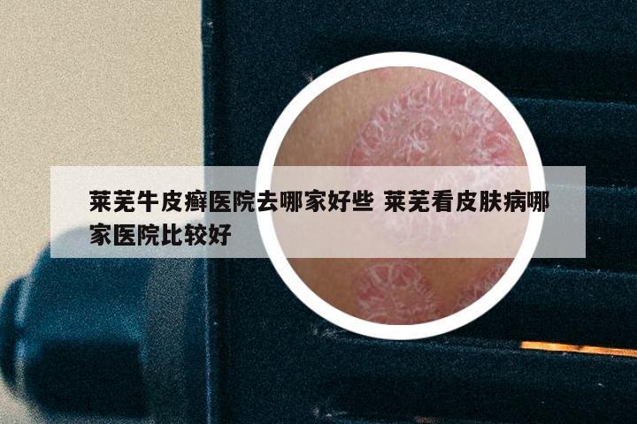 莱芜牛皮癣医院去哪家好些 莱芜看皮肤病哪家医院比较好