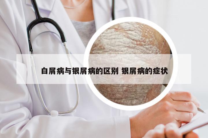白屑病与银屑病的区别 银屑病的症状