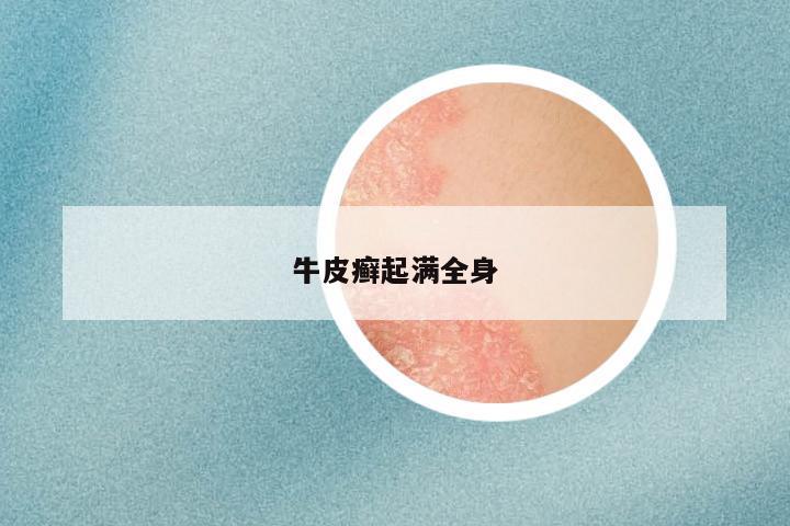 牛皮癣起满全身