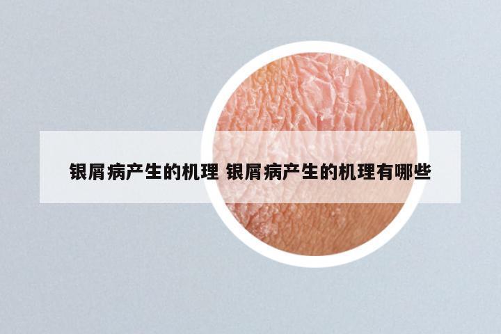 银屑病产生的机理 银屑病产生的机理有哪些