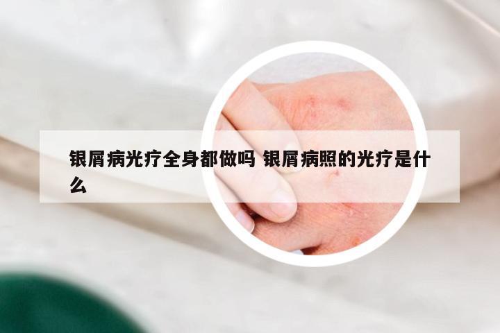 银屑病光疗全身都做吗 银屑病照的光疗是什么