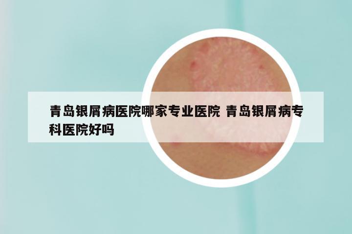 青岛银屑病医院哪家专业医院 青岛银屑病专科医院好吗
