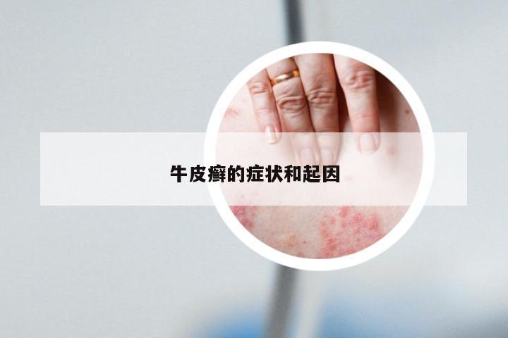 牛皮癣的症状和起因