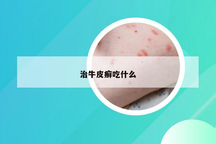 治牛皮癣吃什么