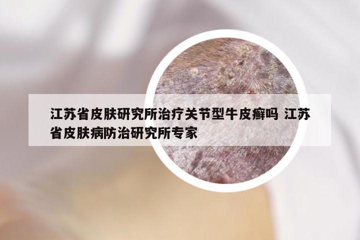 江苏省皮肤研究所治疗关节型牛皮癣吗 江苏省皮肤病防治研究所专家