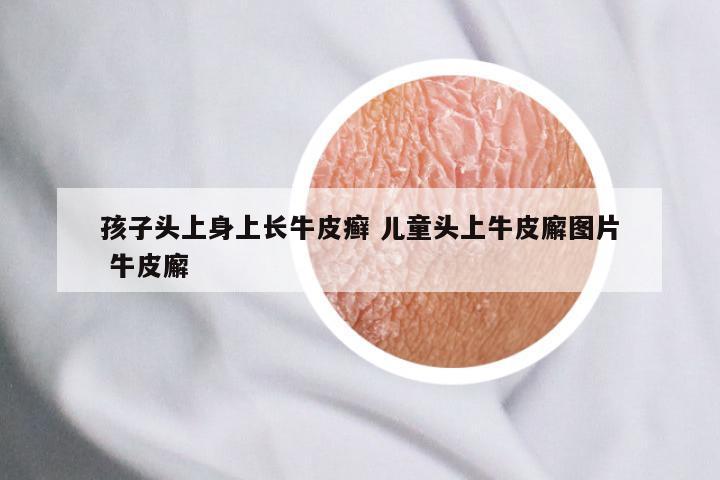 孩子头上身上长牛皮癣 儿童头上牛皮廨图片 牛皮廨