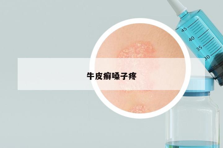 牛皮癣嗓子疼