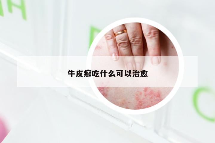 牛皮癣吃什么可以治愈