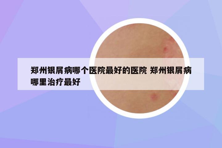 郑州银屑病哪个医院最好的医院 郑州银屑病哪里治疗最好