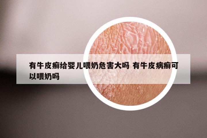 有牛皮癣给婴儿喂奶危害大吗 有牛皮病癣可以喂奶吗
