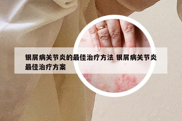 银屑病关节炎的最佳治疗方法 银屑病关节炎最佳治疗方案